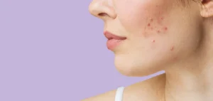 Scopri di più sull'articolo CBD e pelle: cosa è stato studiato e come sono regolati i cosmetici