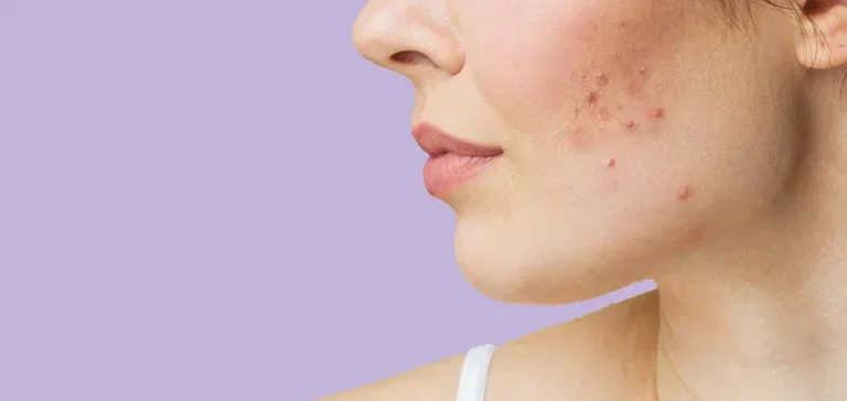 Scopri di più sull'articolo CBD e pelle: cosa è stato studiato e come sono regolati i cosmetici
